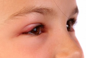 swelling eyes